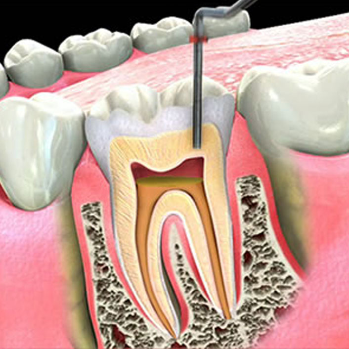Surgical Endodontics - Detail
