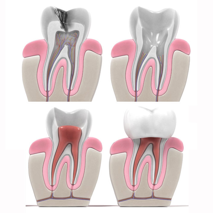 Endodontics - Detail