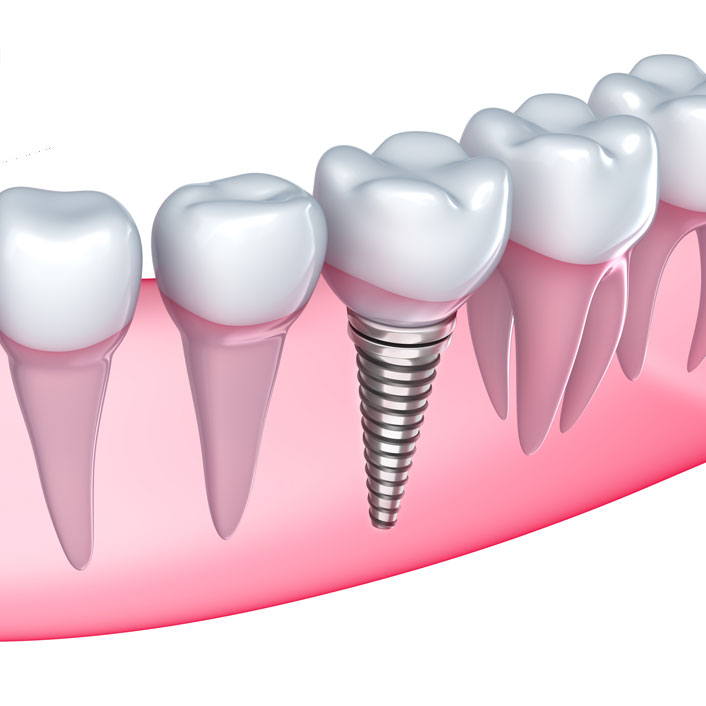 Dental Implants - Detail