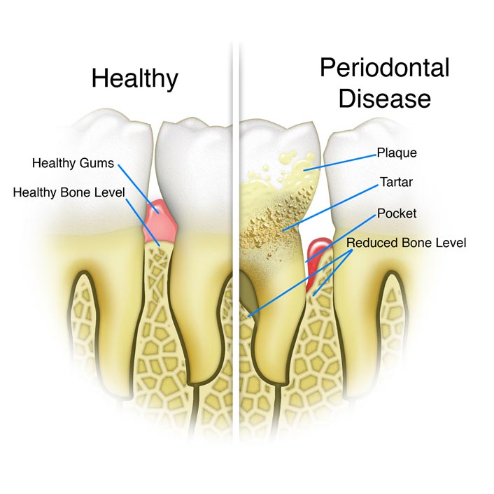 Gum (Perio) Treatments - Detail