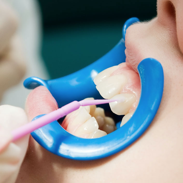 Seymour Dental Sealants