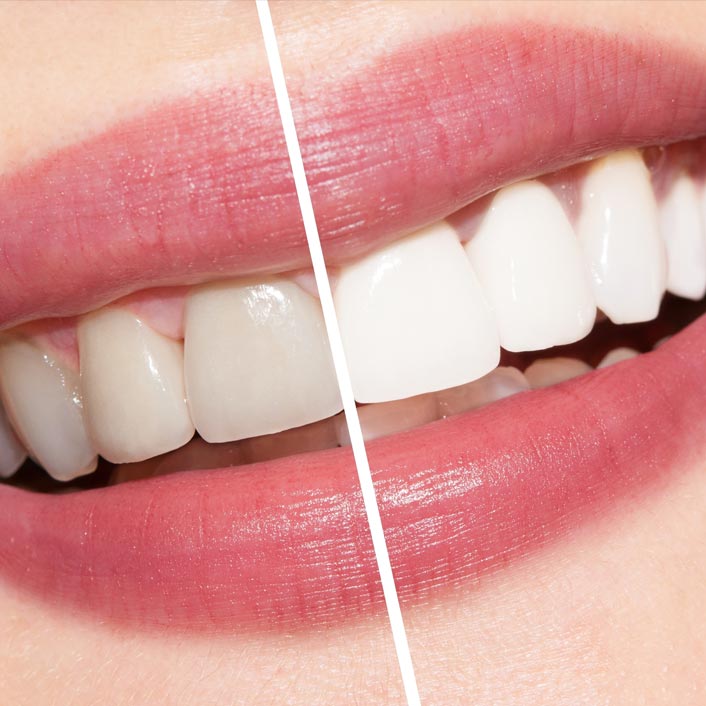 Teeth Whitening - Detail